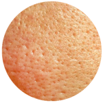 Enlarged Pores